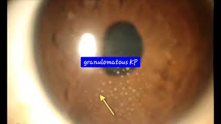 CorneaKeratic precipitatesGranulomatous Keratic precipitates KPOphthalmologyCornea [upl. by Coleman]