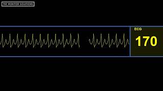 Supraventricular Tachycardia SVT Rhythm Waveform  Simulated Patient Waveform [upl. by Cheslie848]