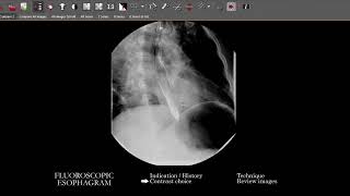 FL Esophagram  Search Pattern [upl. by Eta]