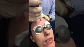 Erbium Yag Laser Treatment using Asclepion MCL31 Dermablate [upl. by Richelle]