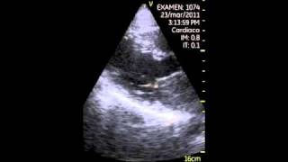 VSCAN left atrial tumor atrial myxoma pocket ultrasound [upl. by Natassia]