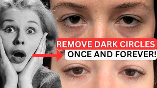 Erase Dark Circles  Expert Tips for Bright UnderEyes [upl. by Roter]