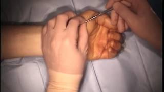 Transtrapezial Approach for Fixation of Acute Scaphoid Fractures [upl. by Ilrac]