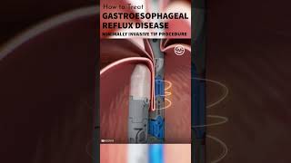 Gastroesophageal Reflux Disease GERD Treatment shorts tutorial medical animation surgmedia [upl. by Derriey]