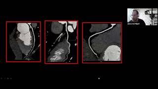 Clase 15  Angiotomografía en la enfermedad coronaria [upl. by Swartz]