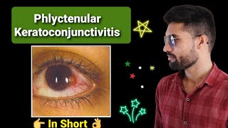 Phlyctenular keratoconjunctivitis lecture opthalmology [upl. by Burrus]