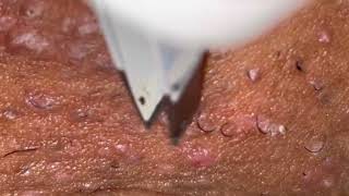 Ingrown Hair Removal 15 [upl. by Reginald]