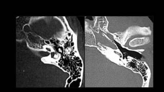 Radiology  Imaging of the Petrous Bone  Skull [upl. by Jahncke128]