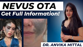 Understanding Nevus of Ota By Dermatologist Dr Anvika [upl. by Atisor]