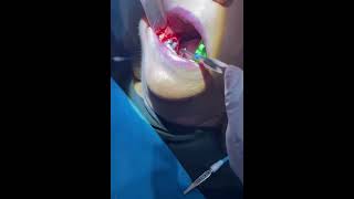 Socket Grafting Application with Cylindrical Bone Insert [upl. by Naawaj]