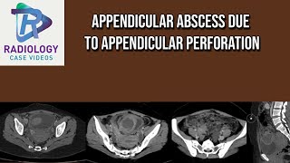 Appendicular abscess due to Appendicular perforation [upl. by Levona220]