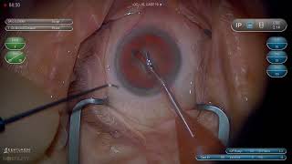 Surgery Phacoemulsification for Beginners [upl. by Iow]