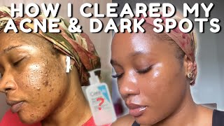 HOW I CLEARED MY ACNE BREAKOUTS AND DARK SPOTS NO TRETINOIN  iJay Amadi [upl. by Vaientina917]