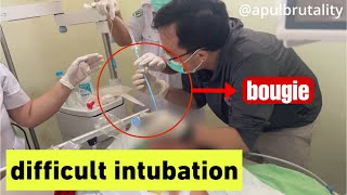 Bougie assisted endotracheal intubation  difficult intubation [upl. by Avlasor]