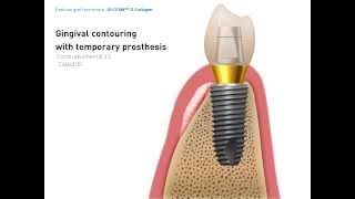 2D Manual Dentium Graft material [upl. by Laveen]