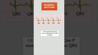 21 AV BLOCK  ECG COURSE  LearningCardiology [upl. by Nanreh]