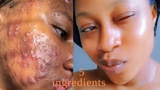 How to Remove Stubborn pimplesDark spotsAcneFast 5 ingredients Get a Glass skinclearacne [upl. by Daniyal]