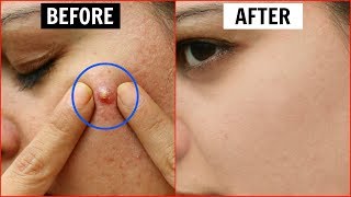 एक ही रात में Pimples हो जाएंगे गायब  Remove Pimples Overnight  Anaysa [upl. by Ariaes867]