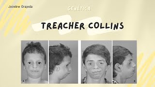 Treacher Collins  Genereviews [upl. by Kurzawa354]