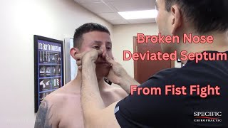 Broken Nose Deviated Septum from Fist Fight [upl. by Goth]