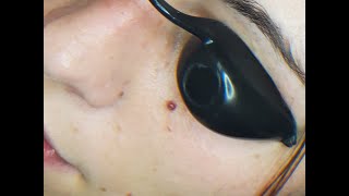 Laser Treatment of Cherry Angiomas [upl. by Shurlocke]