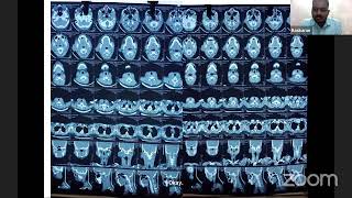 PG CLINICS PAROTID TUMOR SOFT TISSUE TUMOR [upl. by Elisabeth348]