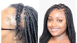 LACE FRONTAL BOX BRAIDS FOR THINNING HAIR  NO WIG NEEDED [upl. by Frodine799]