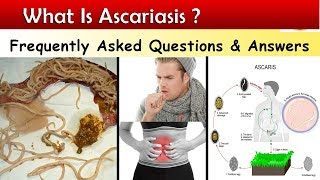 What is Ascariasis   Ascaris Lumbricoids Infections  FAQ [upl. by Adnertal]