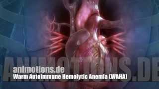 WAHA Warm Autoimmune Hemolytic Anemia AIHA [upl. by Maisey765]