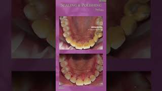 Teeth cleaning  scaling polishing dentistteeth dentalclinic dentist [upl. by Marteena]