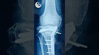 Intraarticular osteotomy [upl. by Hars]