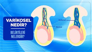 Varikosel Nedir Belirtileri Nelerdir Varikosel Tedavisi ve Ameliyatı Nasıl Yapılır [upl. by Cyrano]