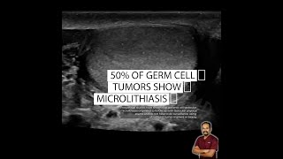 Testicular microlithiasis Should we worry [upl. by Zachar]