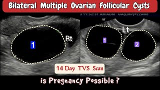 TVS Ultrasound  Bilateral multiple Ovarian Follicular Cysts [upl. by Zaneski543]