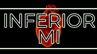 Inferior MI [upl. by Aicilf]