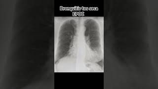 BRONQUITIS TOS SECA EPOC [upl. by Navets]