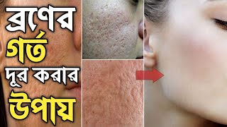 ব্রণের গর্ত দূর করার উপায়  Ways to remove acne holes Tips to remove old skin spots [upl. by Spevek]