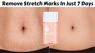 Bio Oil To Remove Stretch Marks In Just 7 Days  Get Rid Of Stretch Marks Easily At Home [upl. by Ynehteb691]