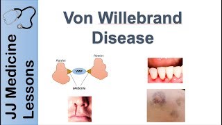 Von Willebrand Disease  Pathophysiology Types Symptoms and Treatment [upl. by Nellac939]