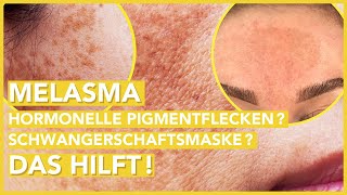 MELASMA Behandlung – So wirst Du die Pigmentflecken im Gesicht endlich los [upl. by Aramanta621]