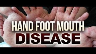 Hand Foot Mouth Disease Food Remedy [upl. by Hirz]