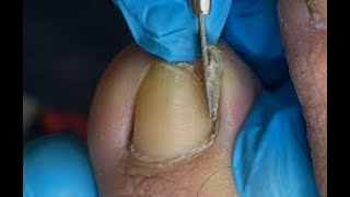 TRIMMING EXTREMELY THICK TOENAILS  FULL TREATMENT [upl. by Llehcor]