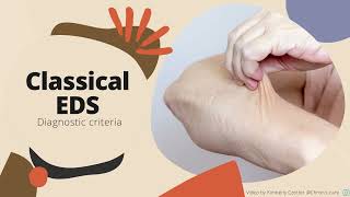 Classical EhlersDanlos Syndrome Diagnostic Criteria [upl. by Atikim]