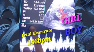 Live Fetal Heartbeat❤️ Sound With Fundoanterior Placenta  Pregnancy With IUCD  Heartrate BoyGirl [upl. by Anahoj]