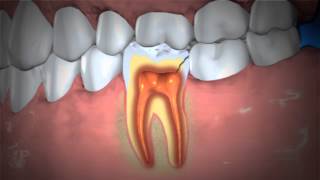 Treatment of Abscessed Teeth [upl. by Idonna662]