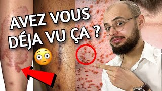 10 signes de DIABETE sur LA PEAU [upl. by Nnahgaem312]