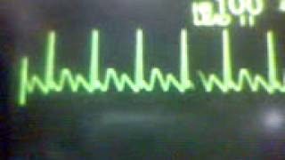 ECG Video Atrial Flutter [upl. by Meela865]