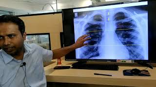 Chest Xray made easy to read  Hindi [upl. by Ilagam]