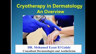 Cryotherapy in Dermatology [upl. by Redlac]