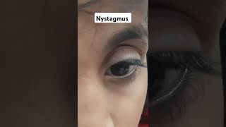 NYSTAGMUS [upl. by Caasi]